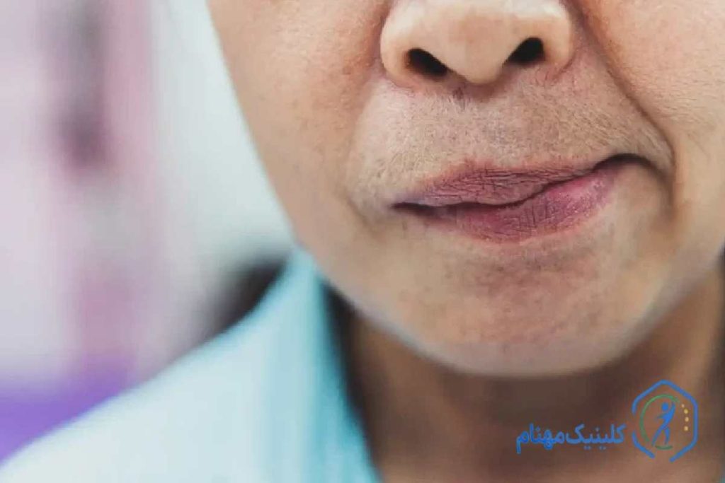 تشخیص فلج بلز و سکته مغزی