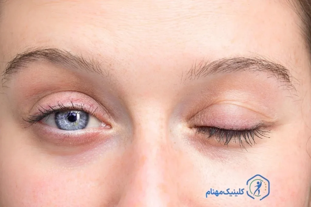 درمان فلج صورت با فیزیوتراپی