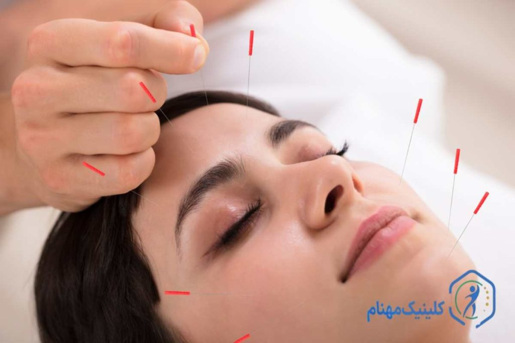 درمان فلج صورت با طب سوزنی