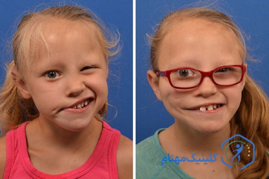 فلج بلز در کودکان