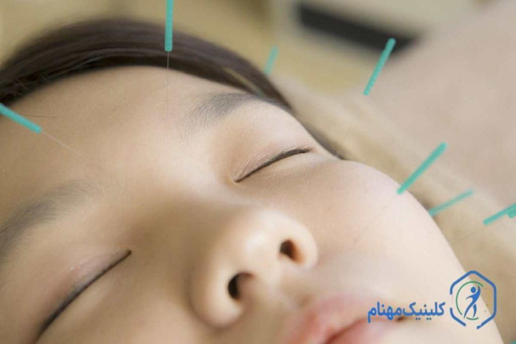 درمان فلج صورت با طب سوزنی