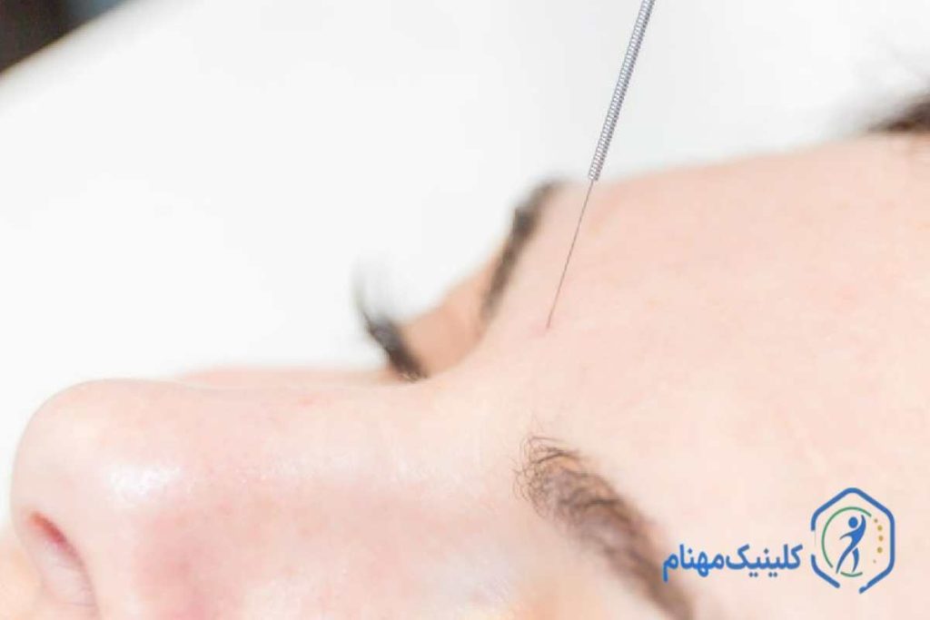 درمان فلج بلز با طب سوزنی