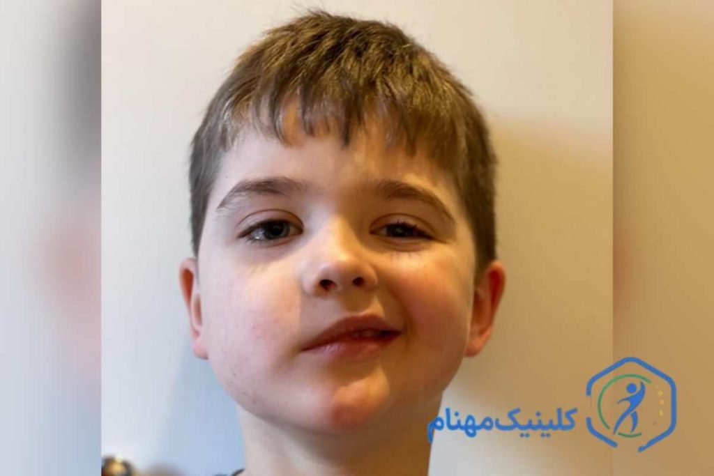 فلج بلز مادرزادی در کودکان